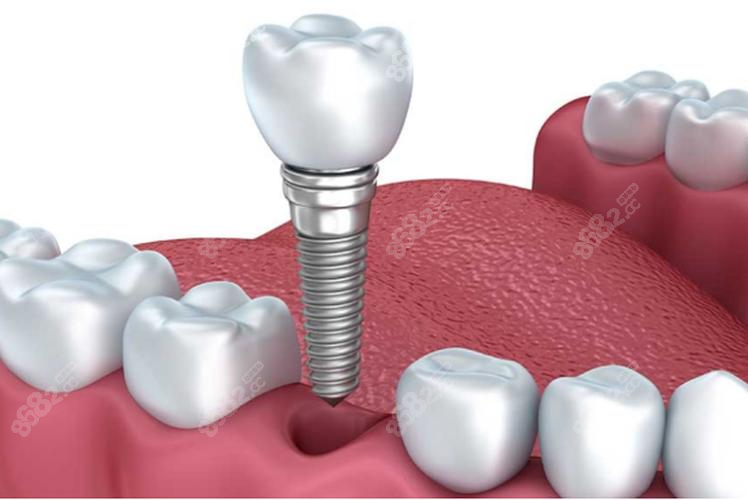 種植牙結(jié)構(gòu)示意圖